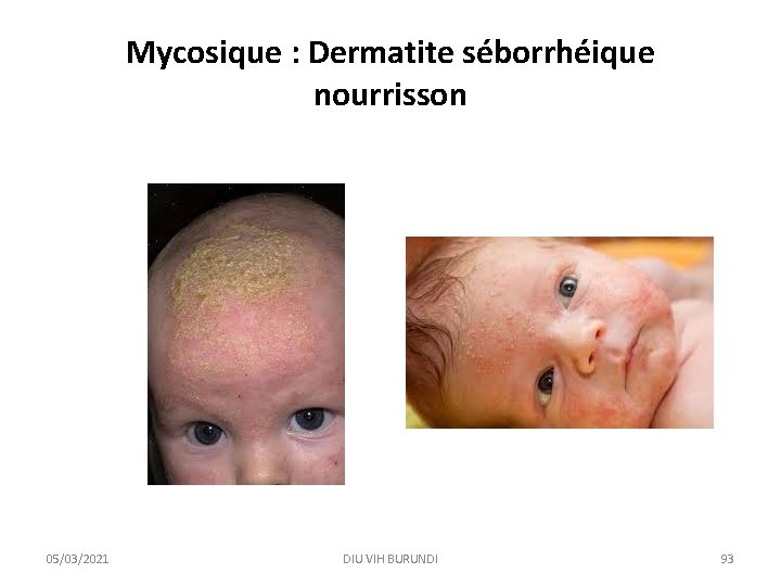 Mycosique : Dermatite séborrhéique nourrisson 05/03/2021 DIU VIH BURUNDI 93 