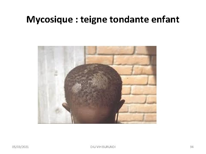 Mycosique : teigne tondante enfant 05/03/2021 DIU VIH BURUNDI 94 