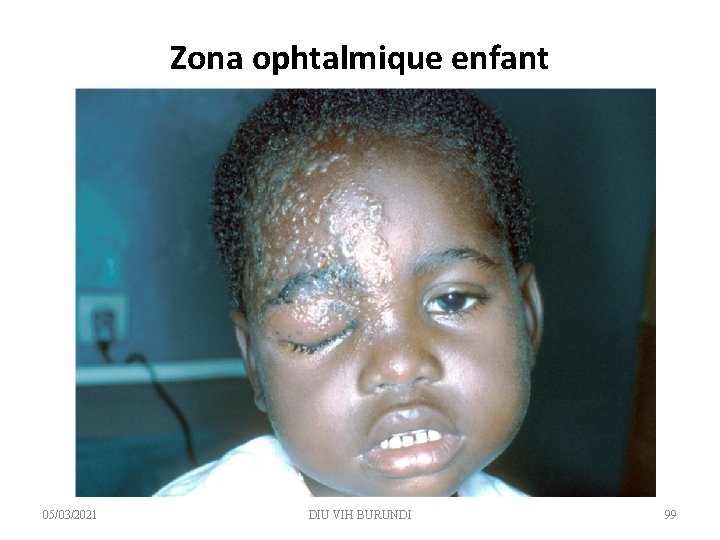 Zona ophtalmique enfant 05/03/2021 DIU VIH BURUNDI 99 