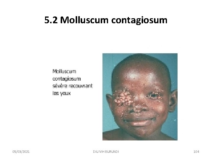 5. 2 Molluscum contagiosum 05/03/2021 DIU VIH BURUNDI 104 5. 2 Molluscum contagiosum 05/03/2021 DIU VIH BURUNDI 104