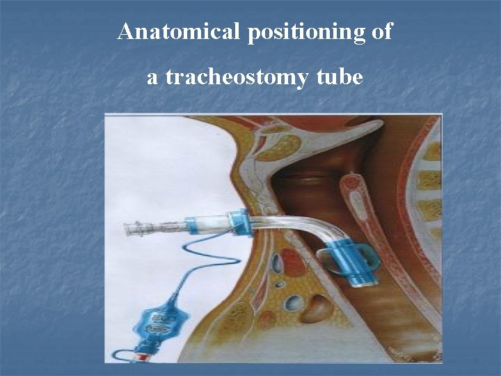 Anatomical positioning of a tracheostomy tube Anatomical positioning of a tracheostomy tube