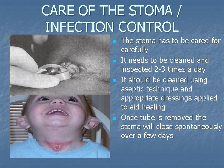 CARE OF THE STOMA / INFECTION CONTROL n n The stoma has to be CARE OF THE STOMA / INFECTION CONTROL n n The stoma has to be