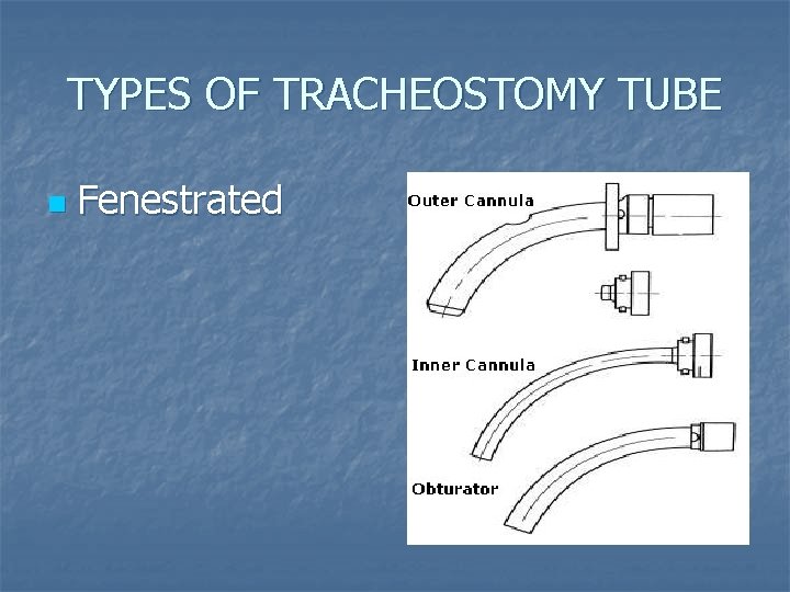 TYPES OF TRACHEOSTOMY TUBE n Fenestrated TYPES OF TRACHEOSTOMY TUBE n Fenestrated