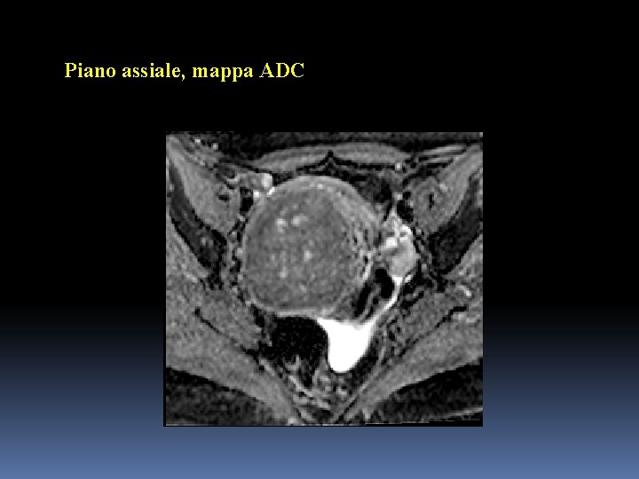 Piano assiale, mappa ADC 