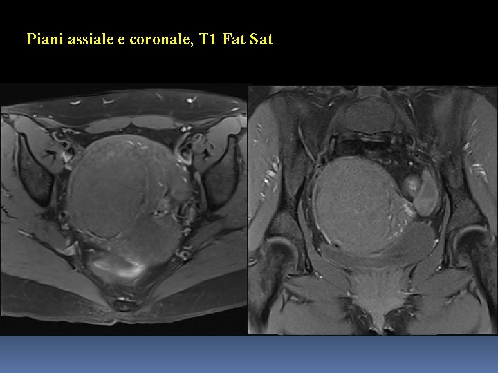 Piani assiale e coronale, T 1 Fat Sat 