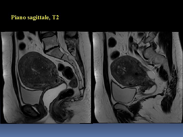 Piano sagittale, T 2 