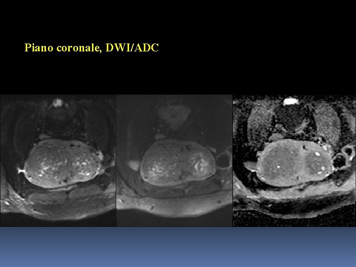 Piano coronale, DWI/ADC 