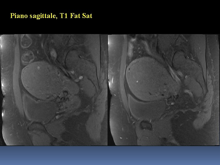 Piano sagittale, T 1 Fat Sat 