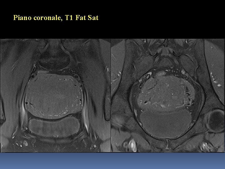 Piano coronale, T 1 Fat Sat 