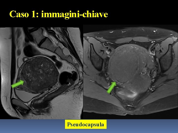 Caso 1: immagini-chiave Pseudocapsula 