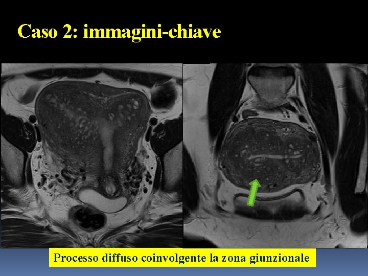 Caso 2: immagini-chiave Processo diffuso coinvolgente la zona giunzionale 