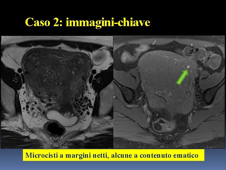 Caso 2: immagini-chiave Microcisti a margini netti, alcune a contenuto ematico 