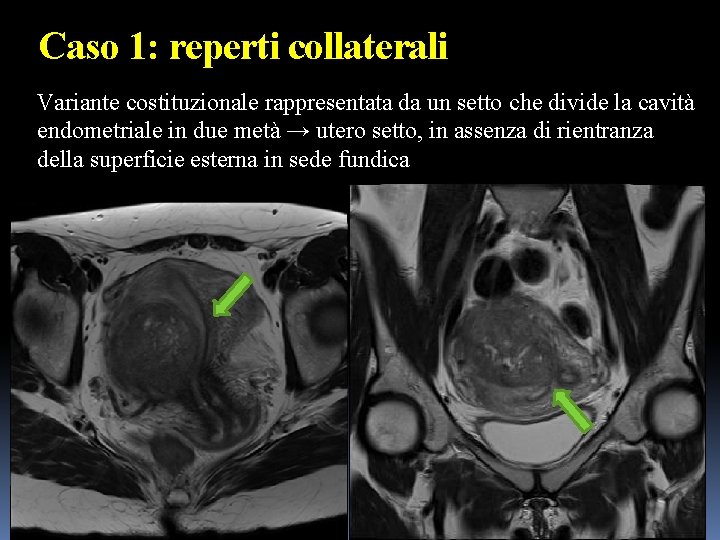 Caso 1: reperti collaterali Variante costituzionale rappresentata da un setto che divide la cavità