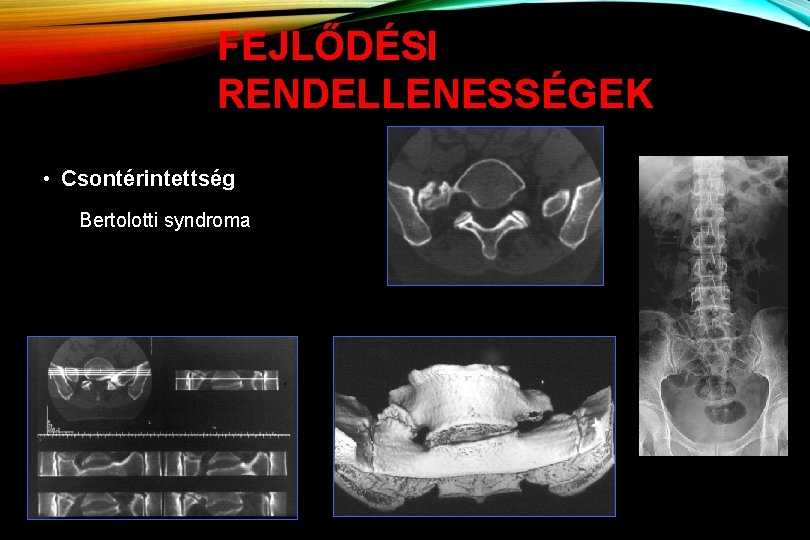 FEJLŐDÉSI RENDELLENESSÉGEK • Csontérintettség Bertolotti syndroma 