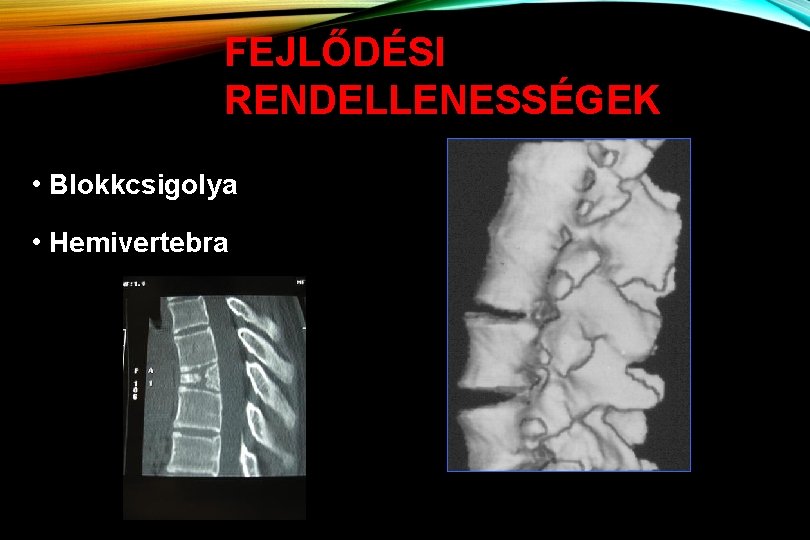 FEJLŐDÉSI RENDELLENESSÉGEK • Blokkcsigolya • Hemivertebra 