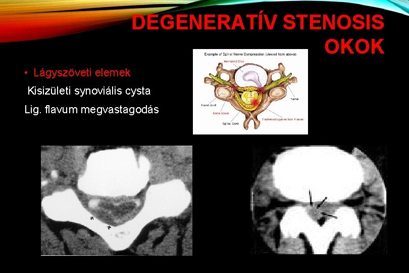 DEGENERATÍV STENOSIS OKOK • Lágyszöveti elemek Kisizületi synoviális cysta Lig. flavum megvastagodás 