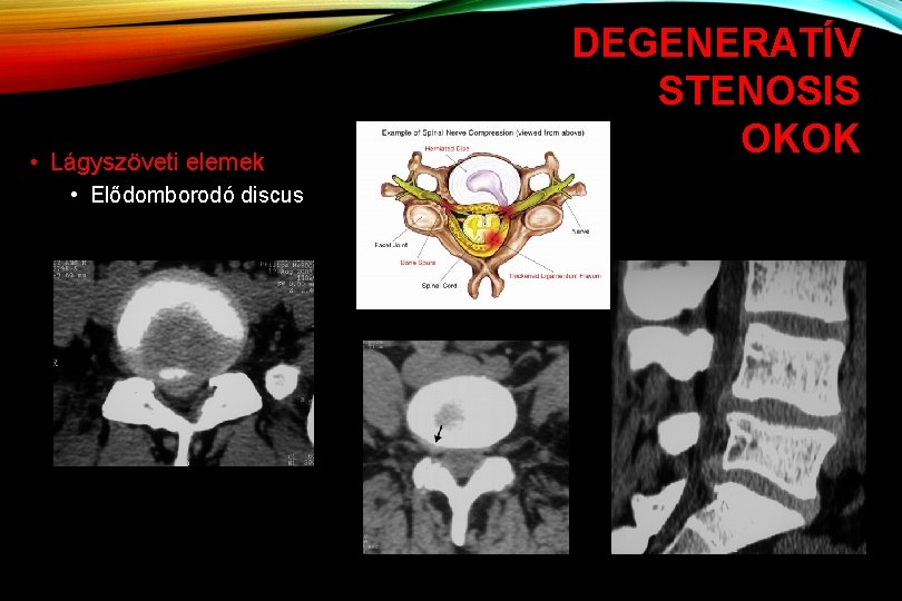  • Lágyszöveti elemek • Elődomborodó discus DEGENERATÍV STENOSIS OKOK 