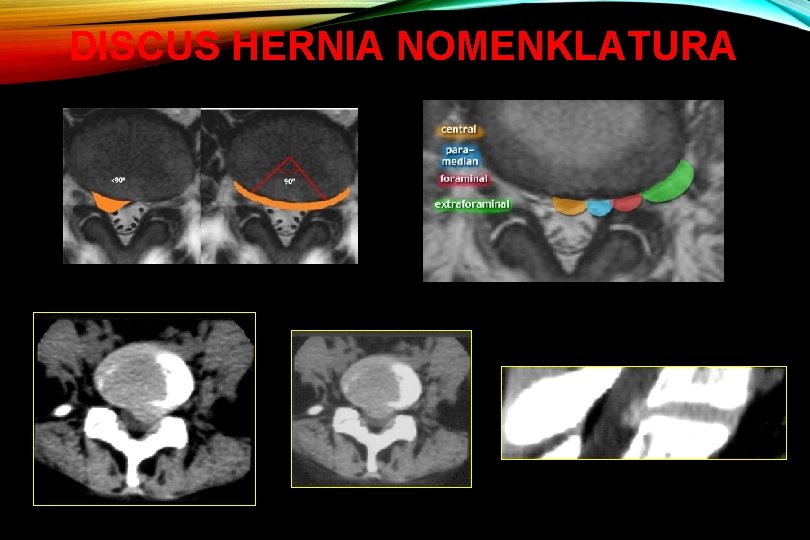 DISCUS HERNIA NOMENKLATURA 