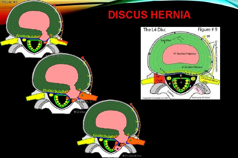 DISCUS HERNIA 