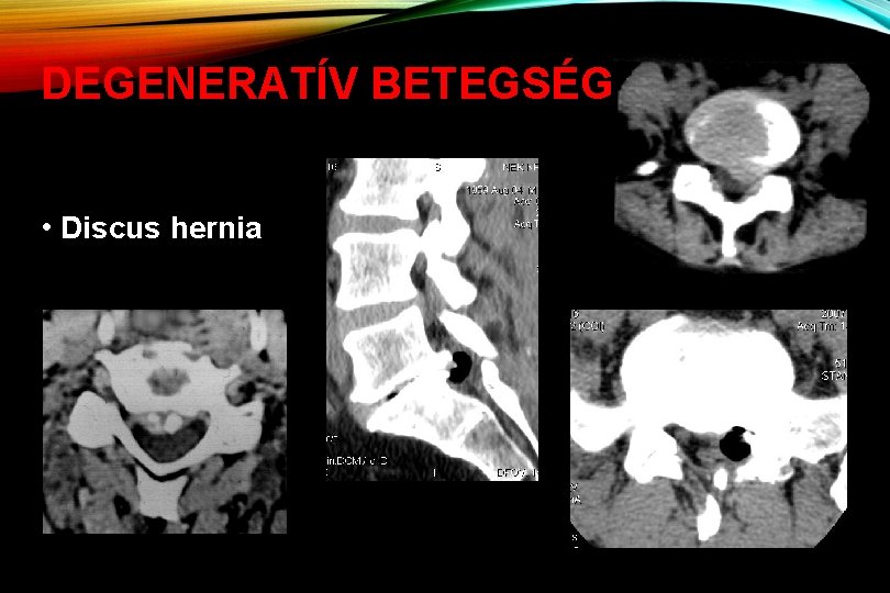 DEGENERATÍV BETEGSÉGEK • Discus hernia 