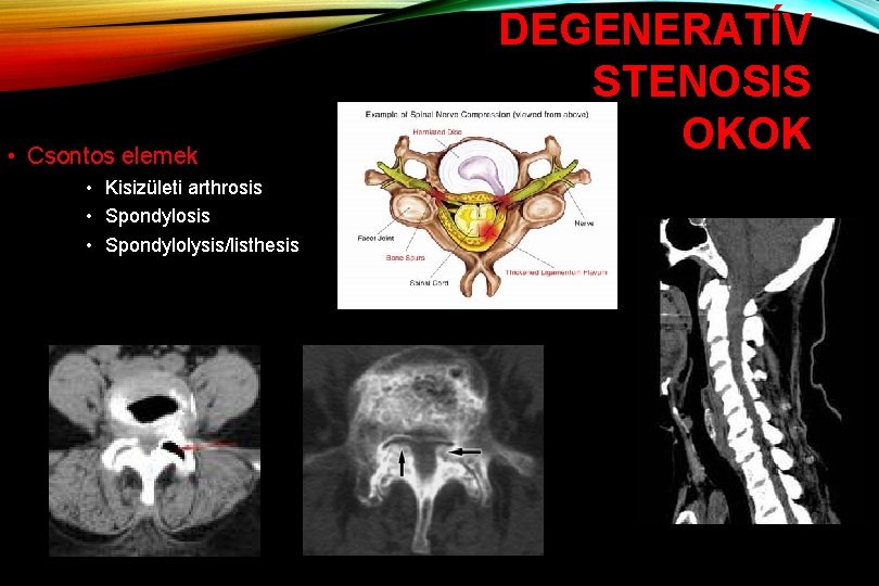  • Csontos elemek • Kisizületi arthrosis • Spondylolysis/listhesis DEGENERATÍV STENOSIS OKOK 