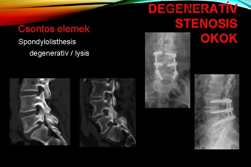 Csontos elemek Spondylolisthesis degeneratív / lysis Másik beteg DEGENERATÍV STENOSIS OKOK 