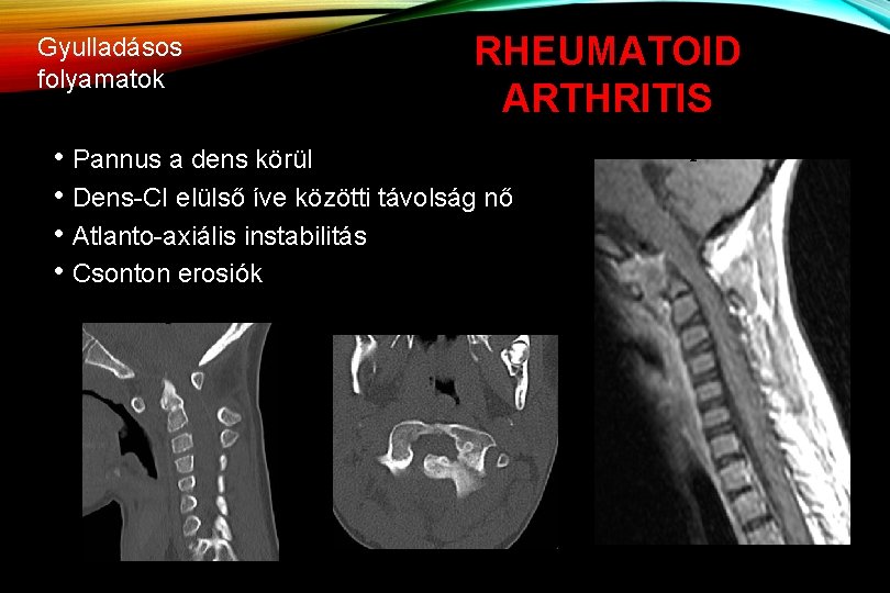 Gyulladásos folyamatok RHEUMATOID ARTHRITIS • Pannus a dens körül • Dens-CI elülső íve közötti