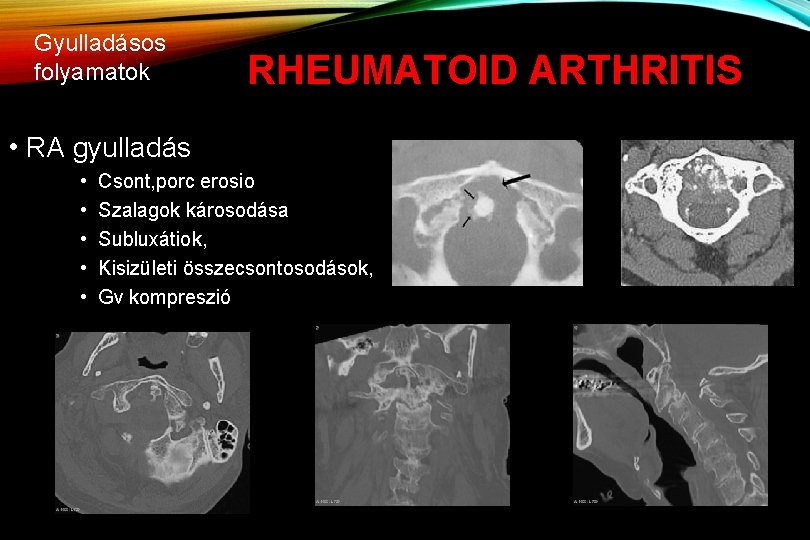 Gyulladásos folyamatok RHEUMATOID ARTHRITIS • RA gyulladás • • • Csont, porc erosio Szalagok