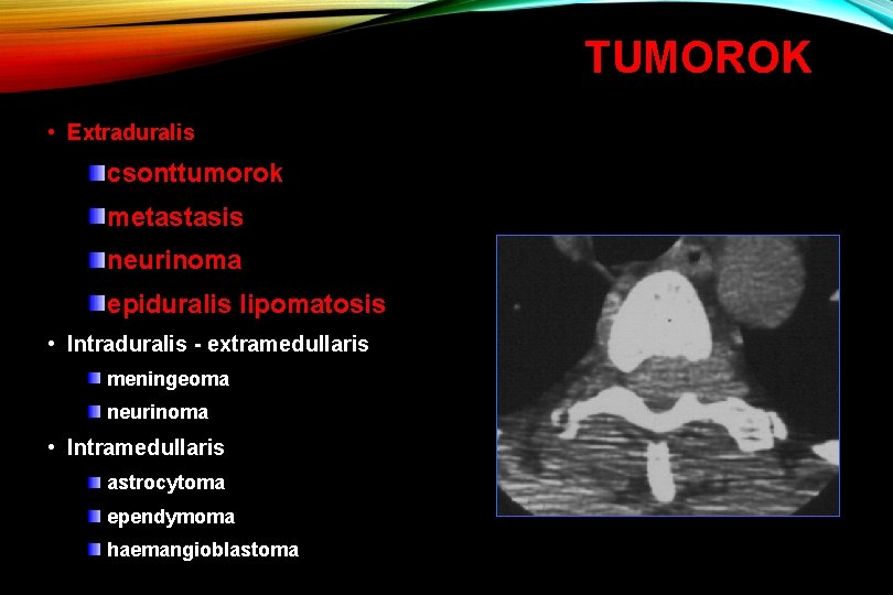 TUMOROK • Extraduralis csonttumorok metastasis neurinoma epiduralis lipomatosis • Intraduralis - extramedullaris meningeoma neurinoma