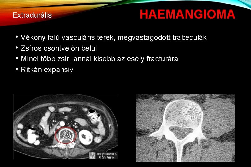 Extradurális HAEMANGIOMA • Vékony falú vasculáris terek, megvastagodott trabeculák • Zsíros csontvelőn belül •