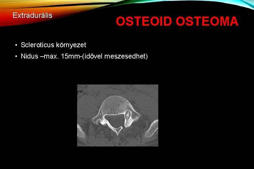 Extradurális OSTEOID OSTEOMA • Scleroticus környezet • Nidus –max. 15 mm-(idővel meszesedhet) 