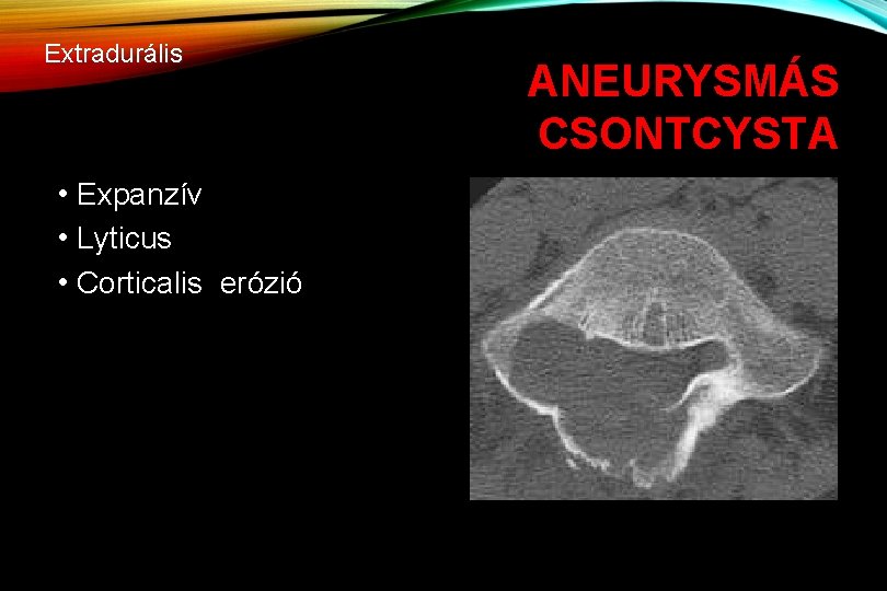 Extradurális • Expanzív • Lyticus • Corticalis erózió ANEURYSMÁS CSONTCYSTA 