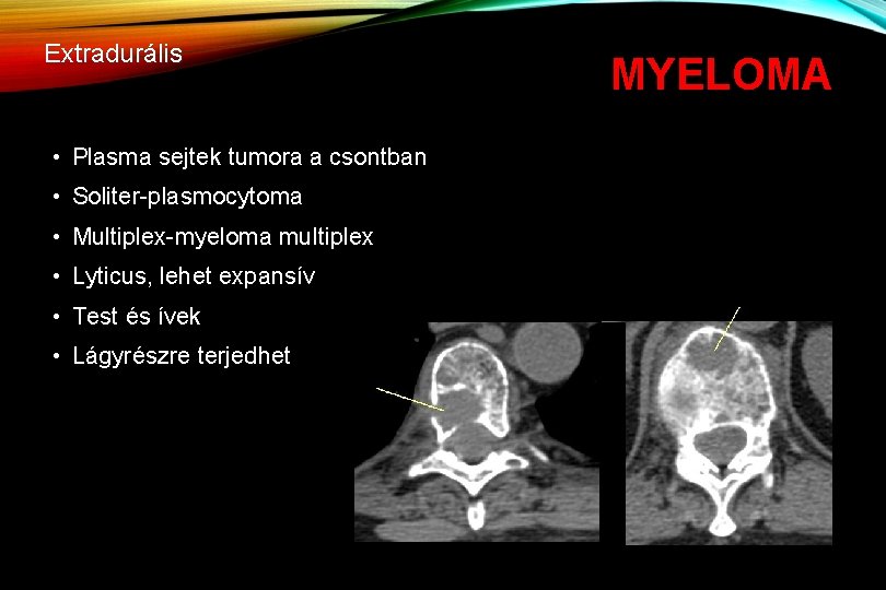Extradurális • Plasma sejtek tumora a csontban • Soliter-plasmocytoma • Multiplex-myeloma multiplex • Lyticus,