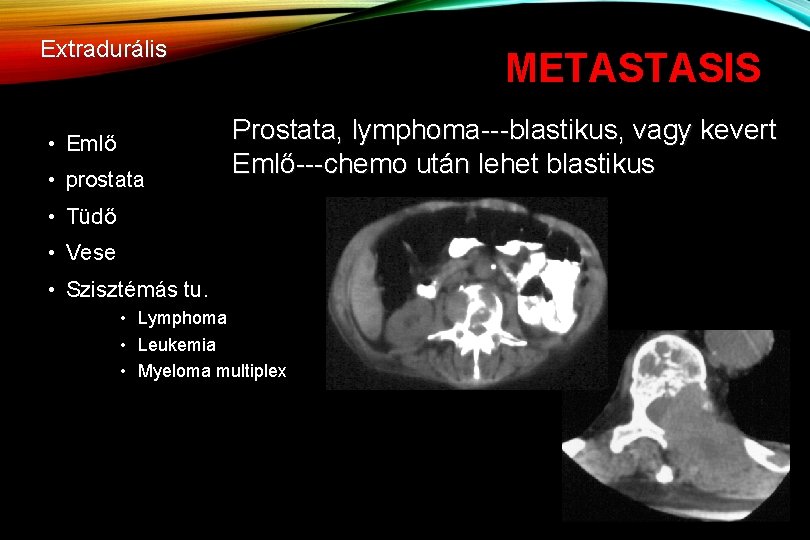 Extradurális • Emlő • prostata METASTASIS Prostata, lymphoma---blastikus, vagy kevert Emlő---chemo után lehet blastikus