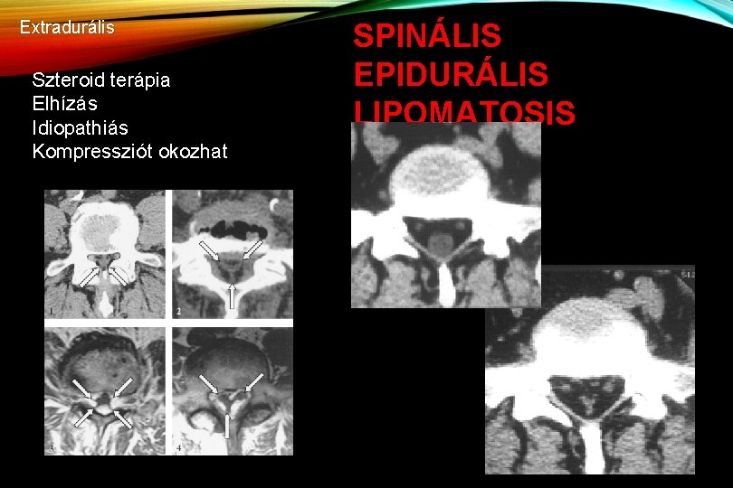 Extradurális Szteroid terápia Elhízás Idiopathiás Kompressziót okozhat SPINÁLIS EPIDURÁLIS LIPOMATOSIS 