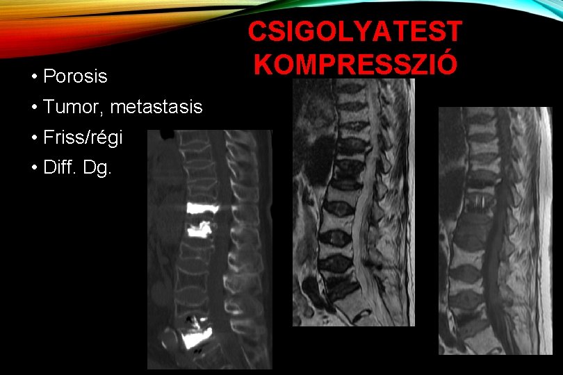  • Porosis • Tumor, metastasis • Friss/régi • Diff. Dg. CSIGOLYATEST KOMPRESSZIÓ 