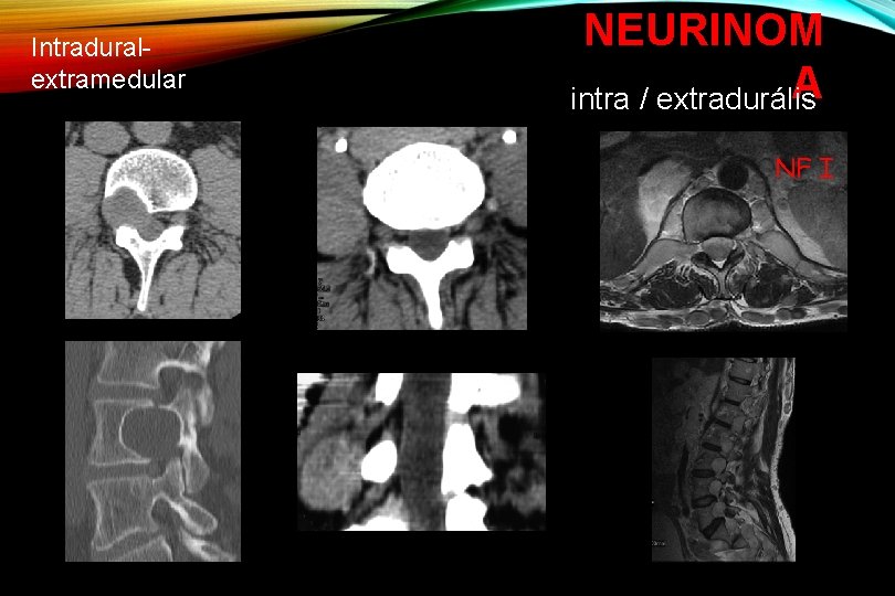 Intraduralextramedular NEURINOM A intra / extradurális NF I 