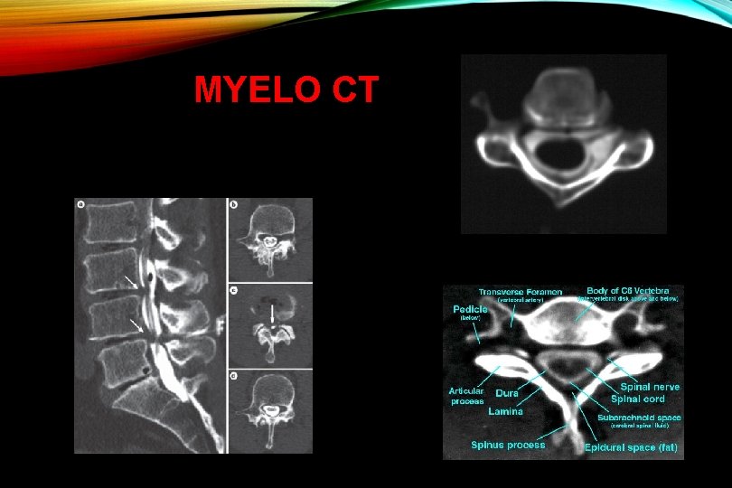 MYELO CT Dura sérülés Gyöksérülés 