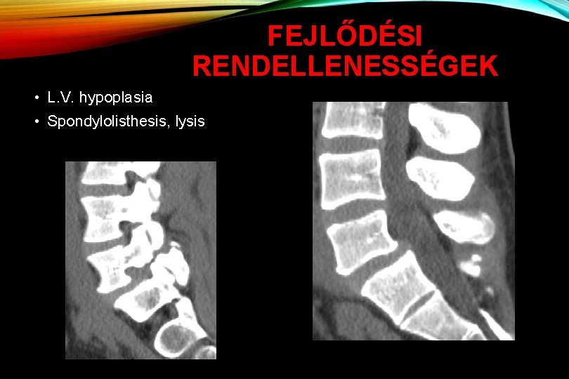 FEJLŐDÉSI RENDELLENESSÉGEK • L. V. hypoplasia • Spondylolisthesis, lysis 