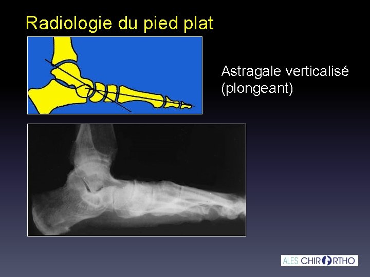 Radiologie du pied plat Astragale verticalisé (plongeant) 