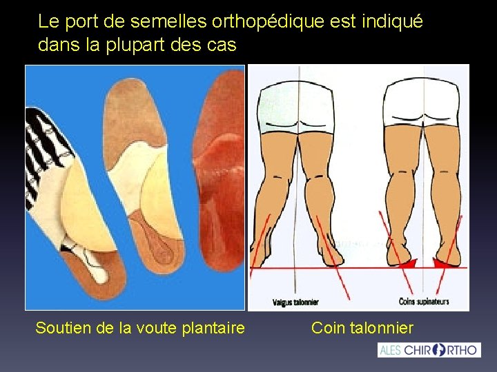 Le port de semelles orthopédique est indiqué dans la plupart des cas Soutien de