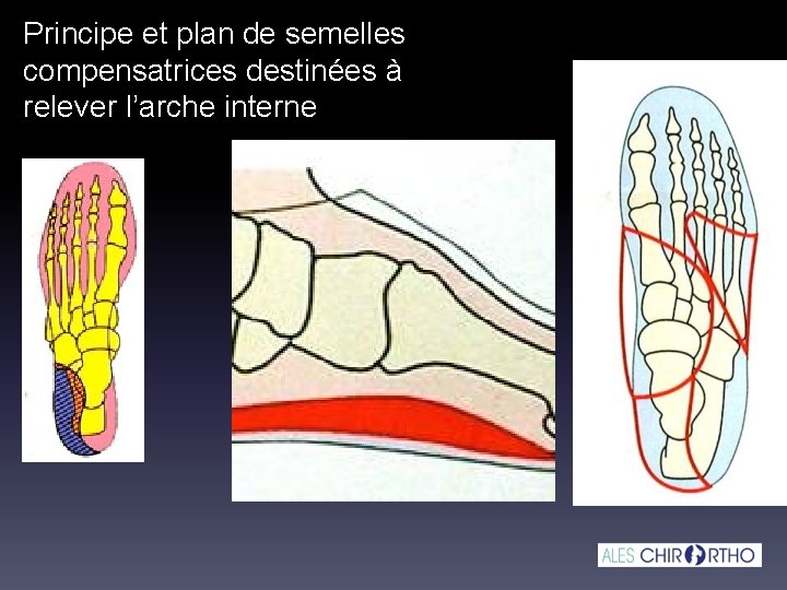 Principe et plan de semelles compensatrices destinées à relever l’arche interne 