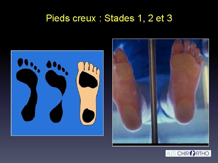 Pieds creux : Stades 1, 2 et 3 