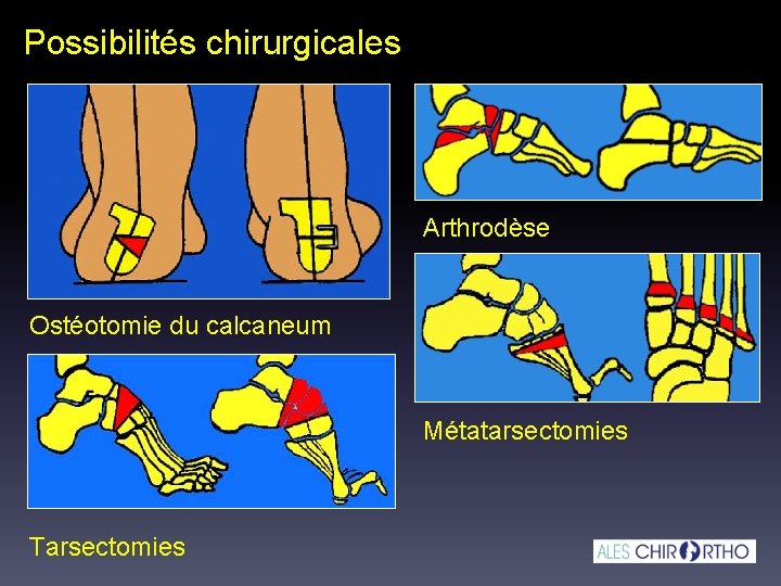 Possibilités chirurgicales Arthrodèse Ostéotomie du calcaneum Métatarsectomies Tarsectomies Possibilités chirurgicales Arthrodèse Ostéotomie du calcaneum Métatarsectomies Tarsectomies