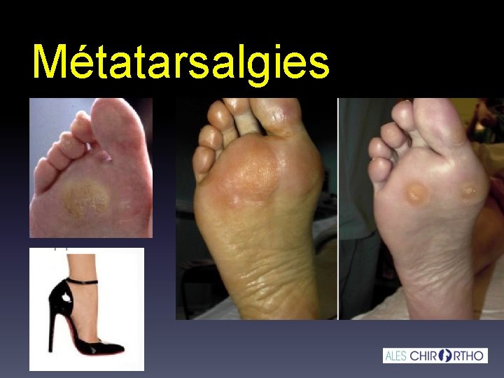 Métatarsalgies 