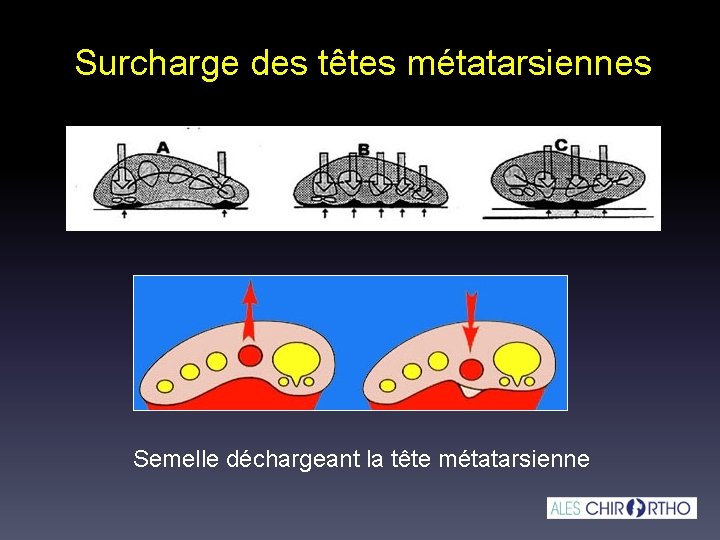 Surcharge des têtes métatarsiennes Semelle déchargeant la tête métatarsienne 