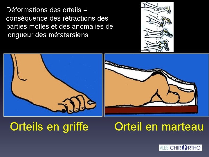 Déformations des orteils = conséquence des rétractions des parties molles et des anomalies de Déformations des orteils = conséquence des rétractions des parties molles et des anomalies de