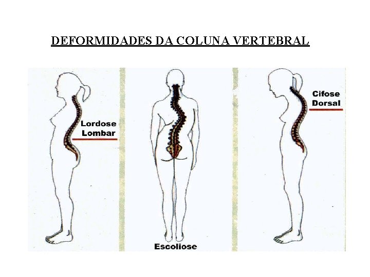 DEFORMIDADES DA COLUNA VERTEBRAL DEFORMIDADES DA COLUNA VERTEBRAL