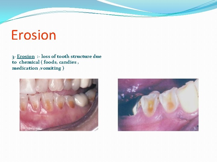 Erosion 3 - Erosion : - loss of tooth structure due to chemical (