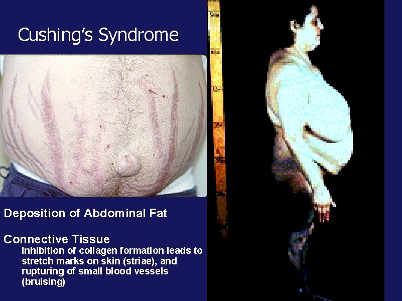 Cushing’s Syndrome Deposition of Abdominal Fat Connective Tissue Inhibition of collagen formation leads to Cushing’s Syndrome Deposition of Abdominal Fat Connective Tissue Inhibition of collagen formation leads to